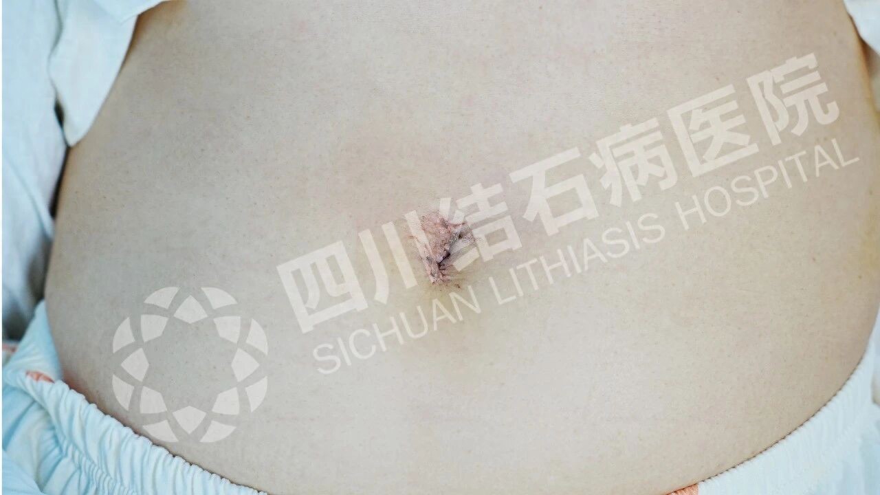 胆囊结石科学处理指南：无症状期，为什么首推“保胆取石”?(图5)