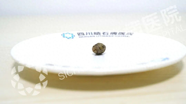 不用带T管！无管化手术实现快速康复【四川保胆取石】(图1)