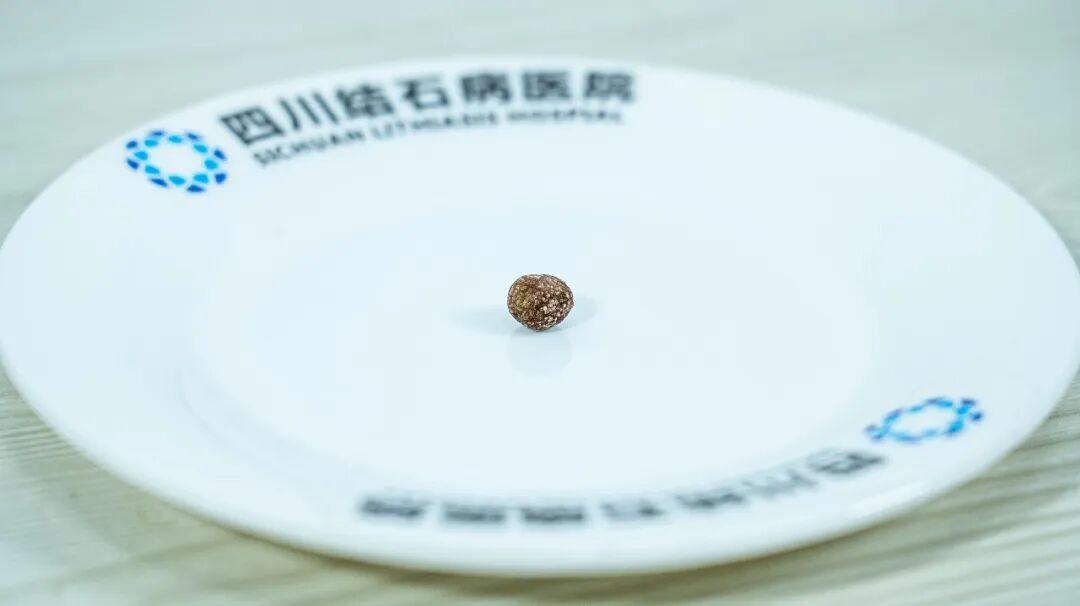 痛心！小小结石嵌顿胆管，遗憾切胆【四川胆结石专科医院】(图1)