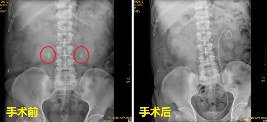盲目碎石吃药,双侧输尿管被“石头”堵死!【四川24小时碎石医院】(图1) 盲目碎石吃药,双侧输尿管被“石头”堵死!【四川24小时碎石医院】(图1)