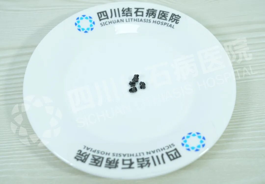 青少年儿童胆结石高发,切还是保?这个暑假很多家长这样选(图1) 青少年儿童胆结石高发,切还是保?这个暑假很多家长这样选(图1)