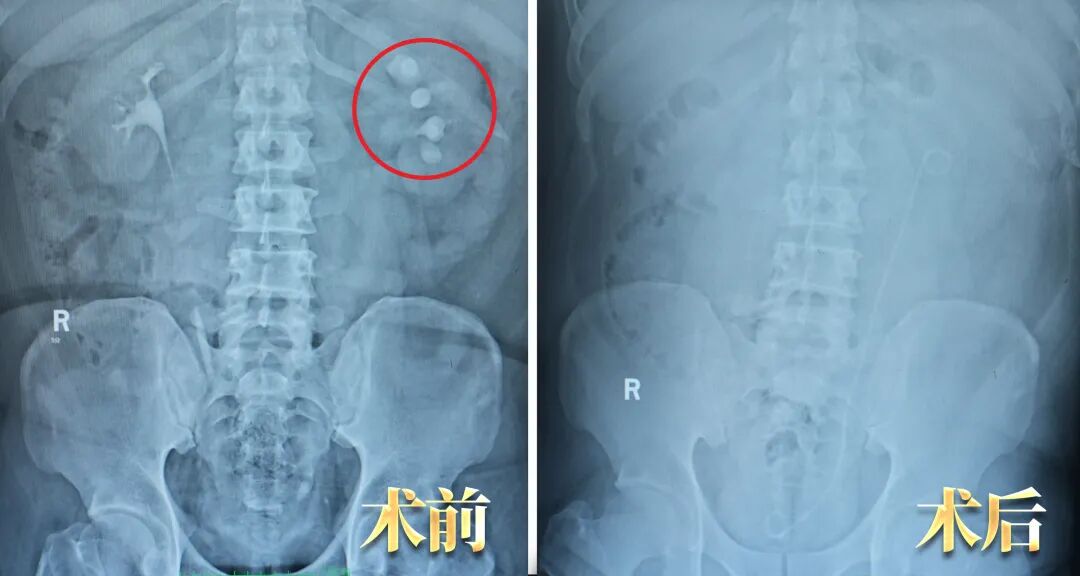 案例分享:反复“尿路感染”一年治不好?真凶竟是它!【四川结石病医院】(图1) 案例分享:反复“尿路感染”一年治不好?真凶竟是它!【四川结石病医院】(图1)