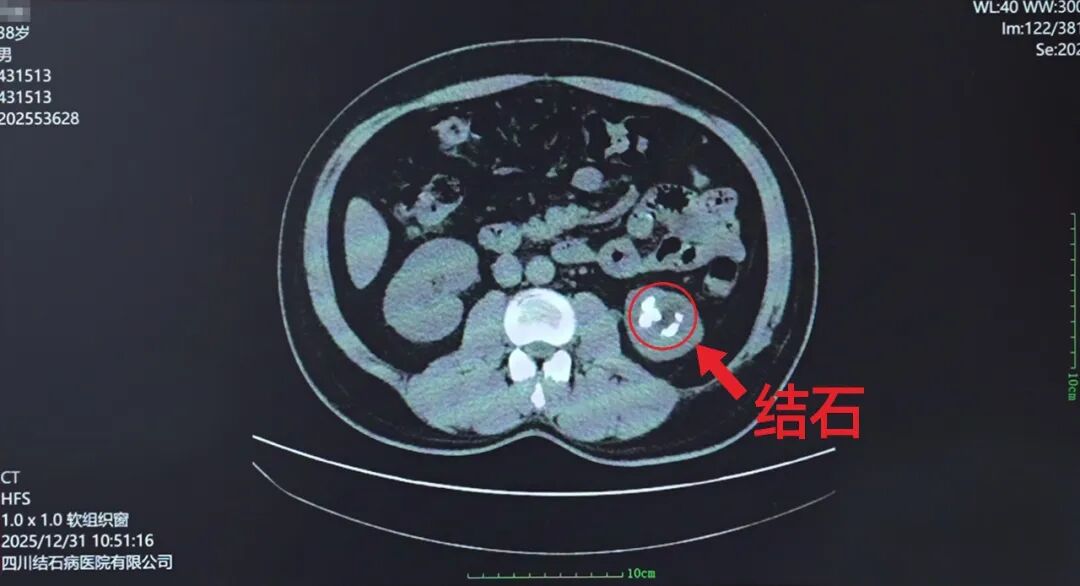 5公分超硬“金刚石”!不打孔如何“智取”【四川肾结石专科医院】(图2) 5公分超硬“金刚石”!不打孔如何“智取”【四川肾结石专科医院】(图2)