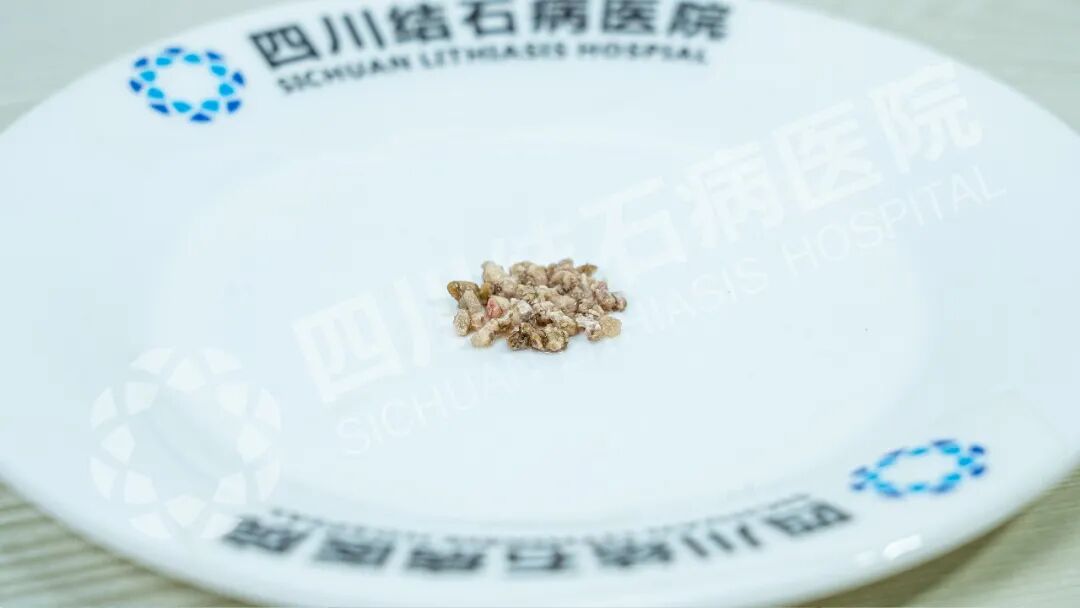 5公分超硬“金刚石”!不打孔如何“智取”【四川肾结石专科医院】(图1) 5公分超硬“金刚石”!不打孔如何“智取”【四川肾结石专科医院】(图1)