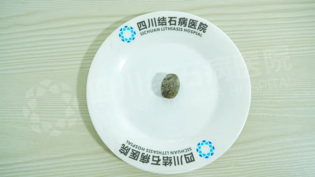 哥哥是医生,为何把他“推”到四川结石病医院保胆?(图1) 哥哥是医生,为何把他“推”到四川结石病医院保胆?(图1)