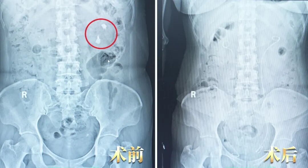 她一句“再等等”“还能忍”，差点毁掉一个肾！【四川肾结石医院】(图1)