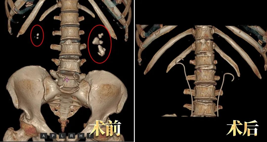 当“独苗”左肾遭遇结石，他这样化解危机【四川肾结石医院】(图1)