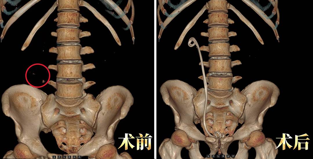 【媒体报道】一米八壮汉痛倒进急诊！这种病夏季高发，六成患者喝水少(图5)