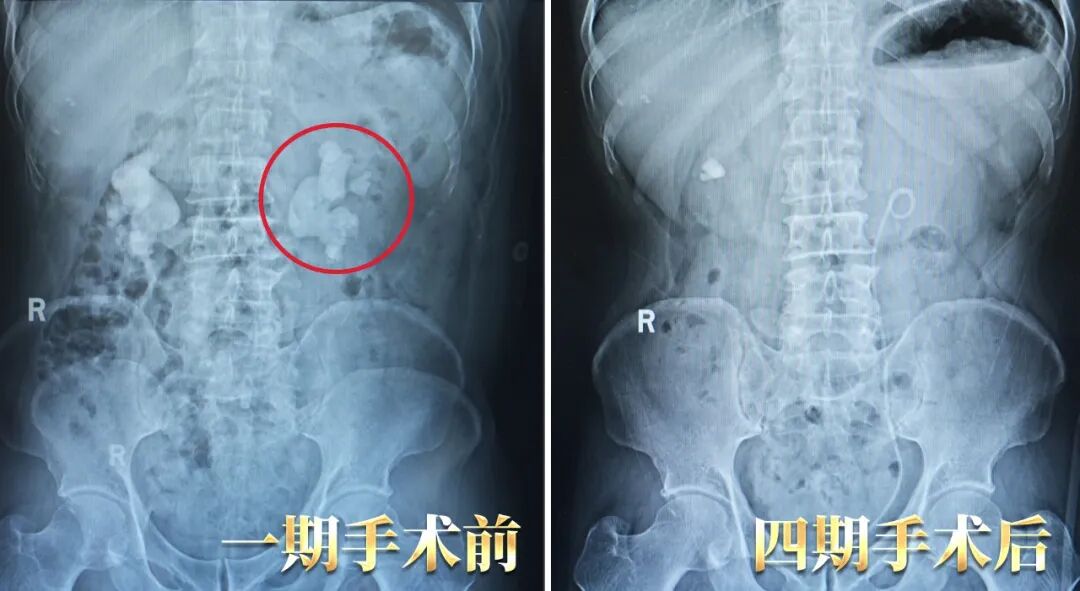高难度铸型结石！看四川结石病医院专家如何精准“拆弹”(图1)