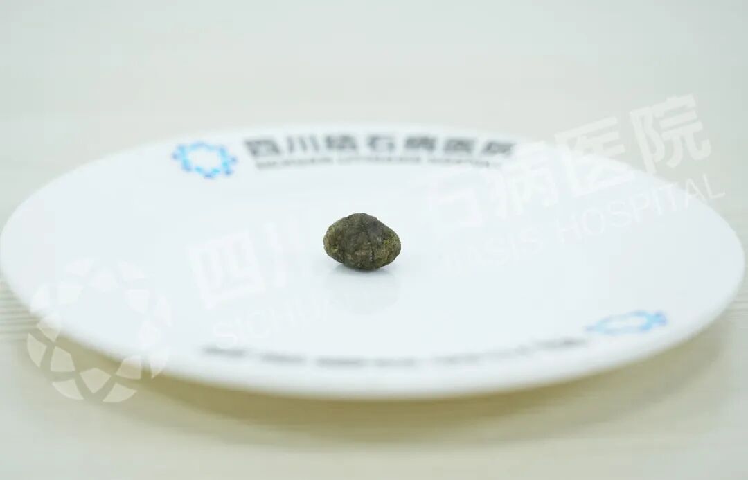 从西藏到成都,一场亲戚间的“保胆”接力【四川保胆取石医院】(图1) 从西藏到成都,一场亲戚间的“保胆”接力【四川保胆取石医院】(图1)