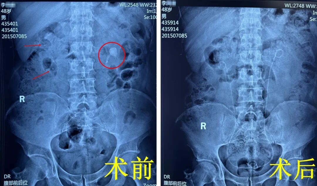 肾结石如“车厘子”般大小？别再盲目治疗了！【四川结石病医院】(图2)