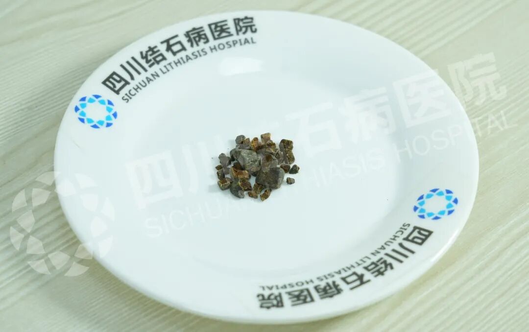 豆包指路：跨越山海！新疆患者奔赴四川结石病医院开启保胆之旅(图1)