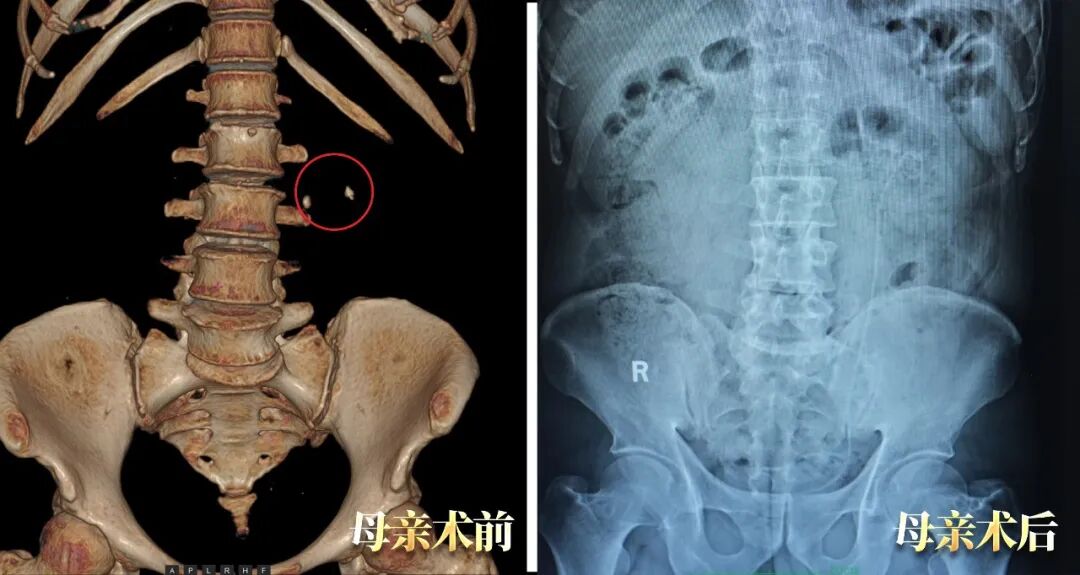 母女俩同患泌尿结石,为何坚定选择四川结石病医院?(图1) 母女俩同患泌尿结石,为何坚定选择四川结石病医院?(图1)