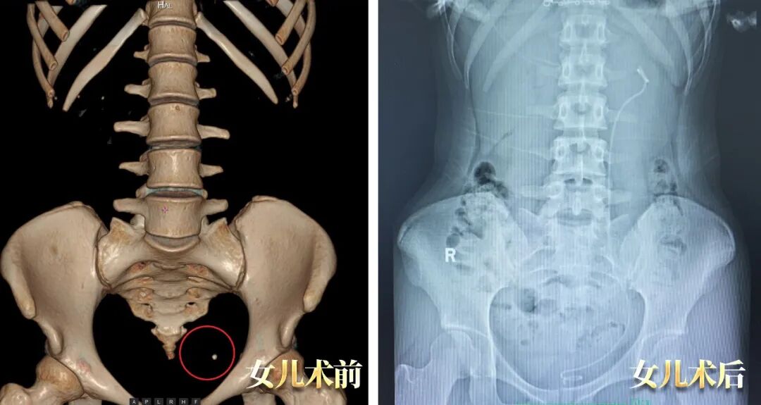 母女俩同患泌尿结石,为何坚定选择四川结石病医院?(图2) 母女俩同患泌尿结石,为何坚定选择四川结石病医院?(图2)