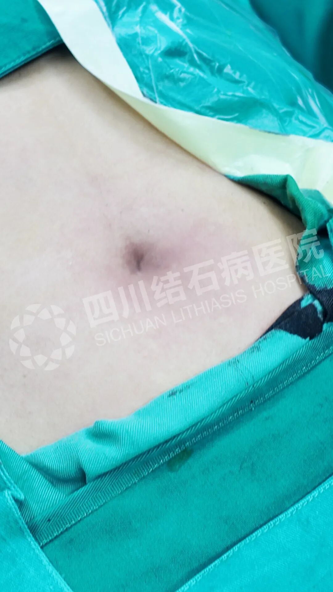 结石拦住追梦路,“隐痕保胆”为他扫清障碍【四川结石病医院】(图1) 结石拦住追梦路,“隐痕保胆”为他扫清障碍【四川结石病医院】(图1)