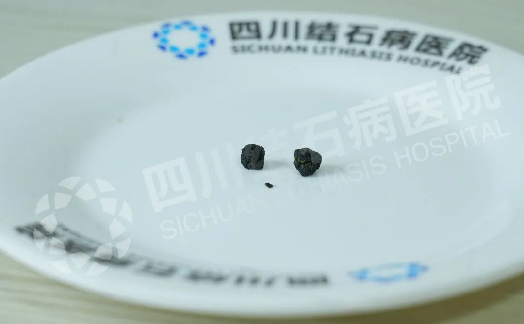 结石拦住追梦路,“隐痕保胆”为他扫清障碍【四川结石病医院】(图2) 结石拦住追梦路,“隐痕保胆”为他扫清障碍【四川结石病医院】(图2)