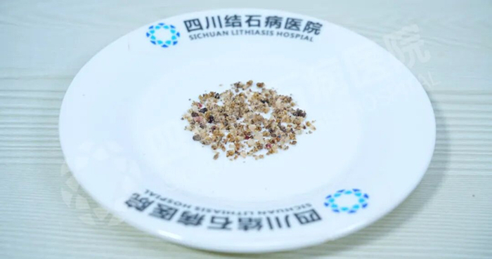 结石患者发出疑问:平时毫无感觉,为何泌尿结石一疼就“要命”?【四川结石病医院】(图2) 结石患者发出疑问:平时毫无感觉,为何泌尿结石一疼就“要命”?【四川结石病医院】(图2)