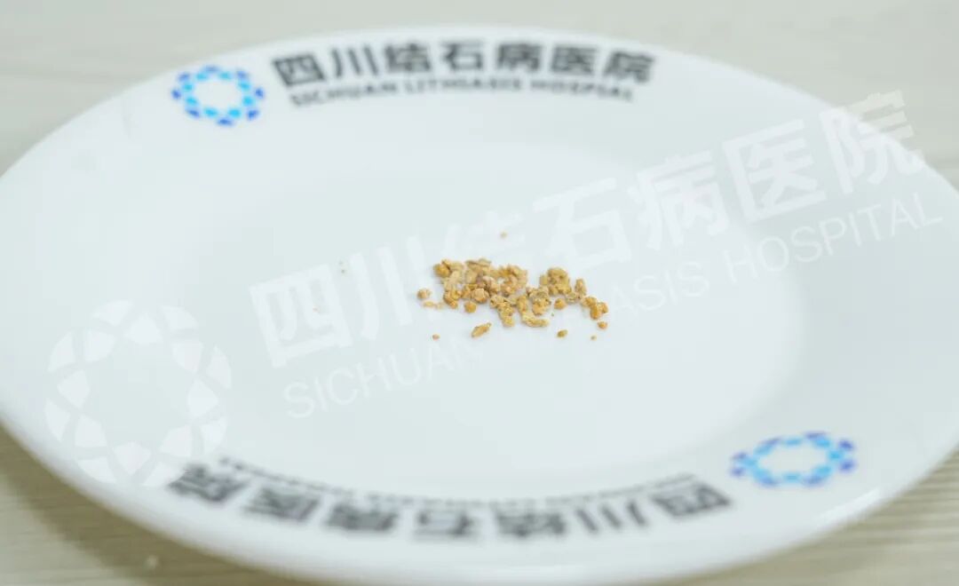 当高龄高危患者遇上胆结石,这场“硬仗”这样打赢【四川结石病医院】(图2) 当高龄高危患者遇上胆结石,这场“硬仗”这样打赢【四川结石病医院】(图2)