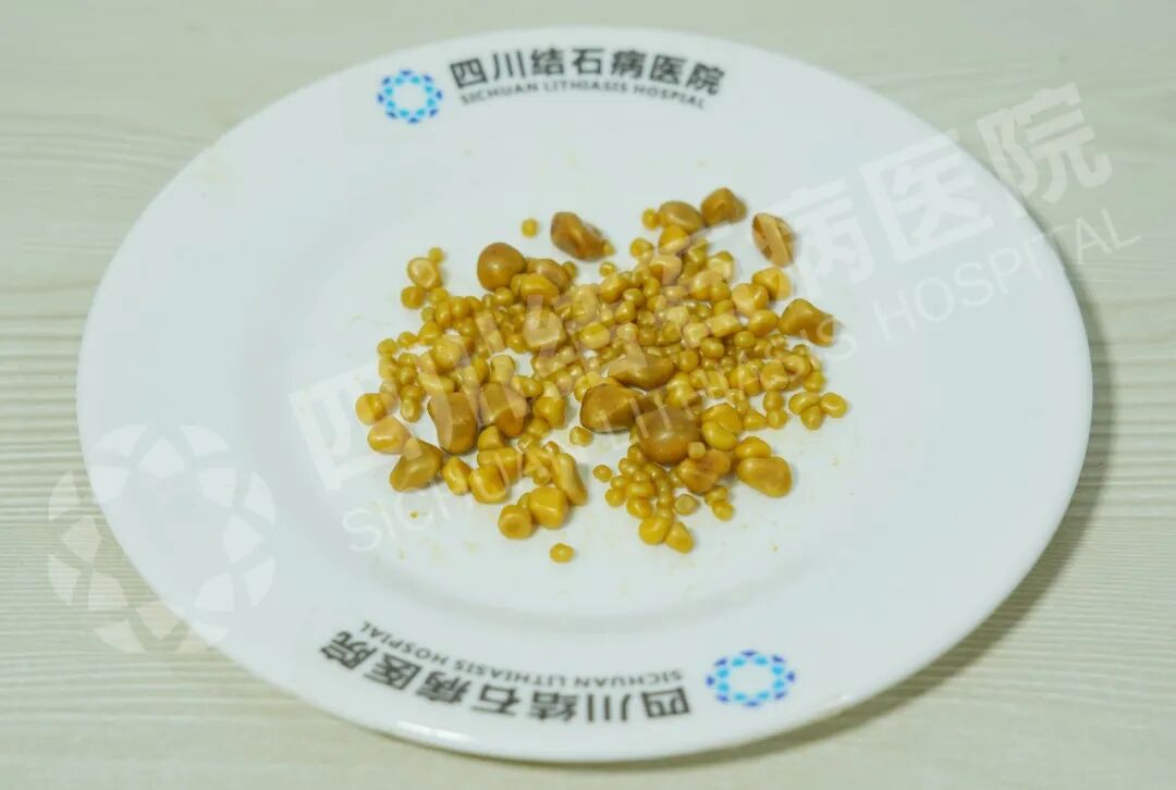 触目惊心!26岁上班族胆囊取出248颗结石,元凶竟是日常外卖(图4) 触目惊心!26岁上班族胆囊取出248颗结石,元凶竟是日常外卖(图4)