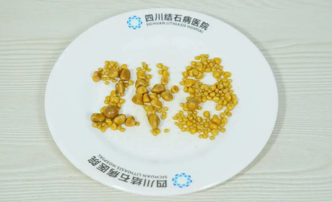 三餐靠外卖,偏爱冒菜炸鸡烧烤,26岁小伙胆囊内取出248颗结石(图1) 三餐靠外卖,偏爱冒菜炸鸡烧烤,26岁小伙胆囊内取出248颗结石(图1)