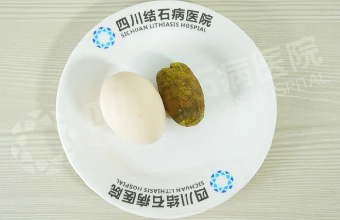 “定时炸弹”被拆除!她在四川结石病医院圆梦保胆(图3) “定时炸弹”被拆除!她在四川结石病医院圆梦保胆(图3)