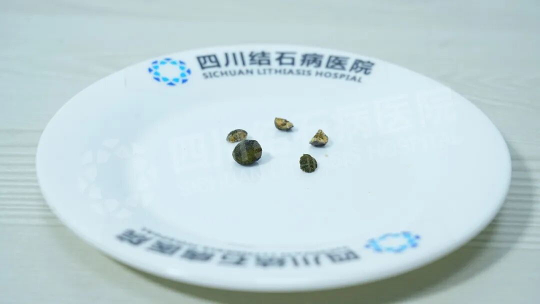 朋友的“强烈推荐”,让她从甘肃奔赴成都保胆【成都保胆取石医院】(图2) 朋友的“强烈推荐”,让她从甘肃奔赴成都保胆【成都保胆取石医院】(图2)
